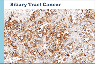Biliary track Cancer