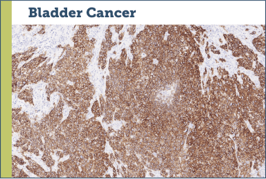 Bladder Cancer