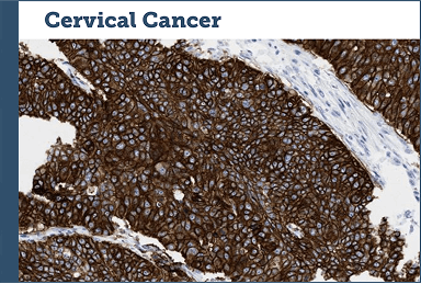 Cervical Cancer