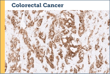 Colorectal Cancer