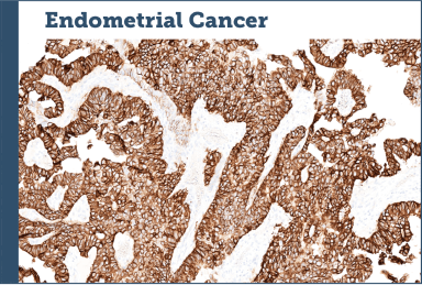 Endometrial Cancer
