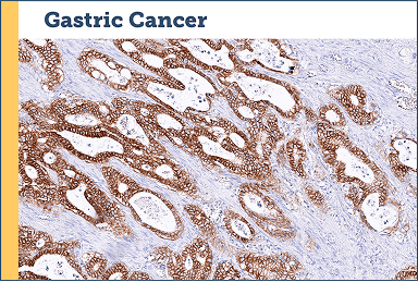 Gastric Cancer