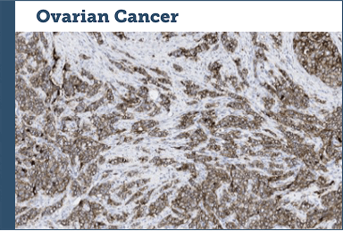 Ovarian Cancer