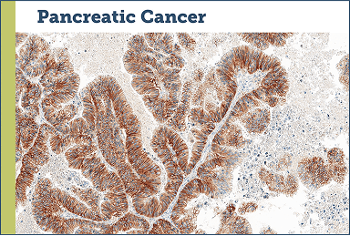 Pancreatic Cancer