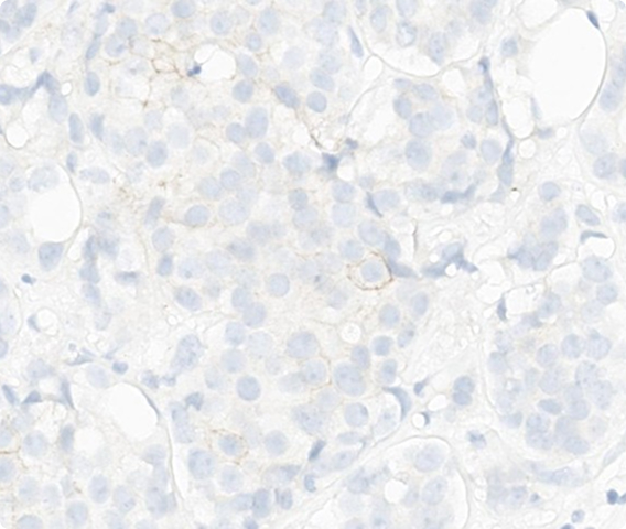 HER2 IHC Score