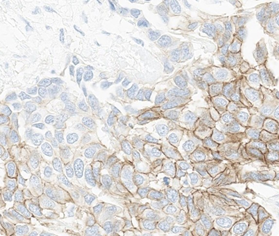 Which HER2 IHC score would you assign to this slide?