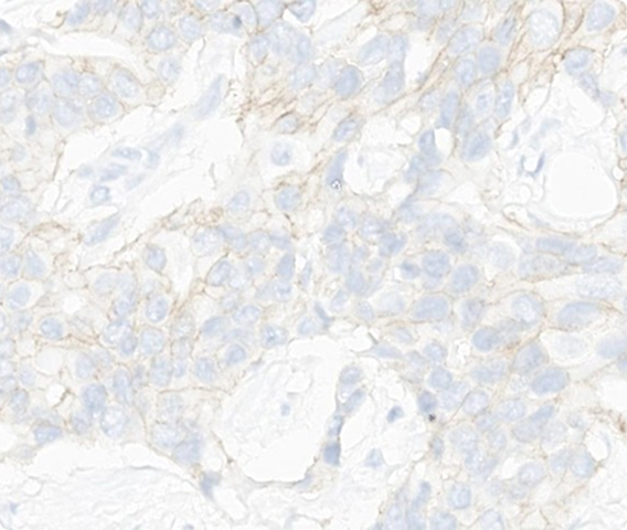 Which HER2 IHC score would you assign to this slide?