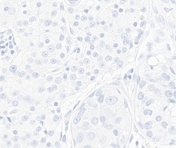 Which HER2 IHC score would you assign to this slide?