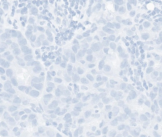 Which HER2 IHC score would you assign to this slide?
