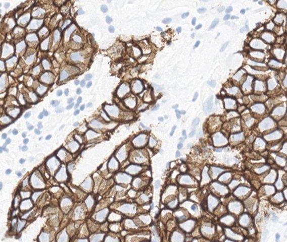 Which HER2 IHC score would you assign to this slide?