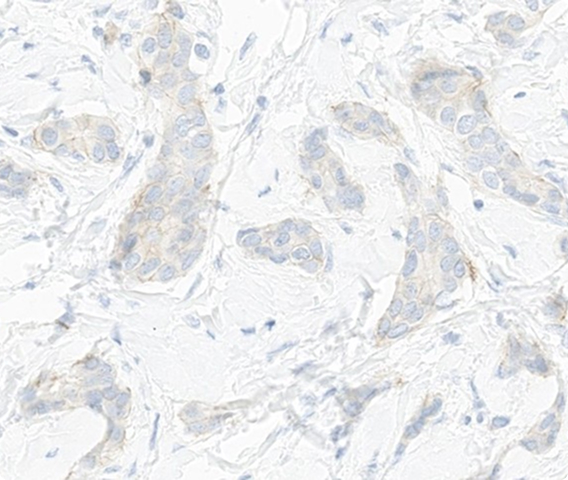 Which HER2 IHC score would you assign to this slide?