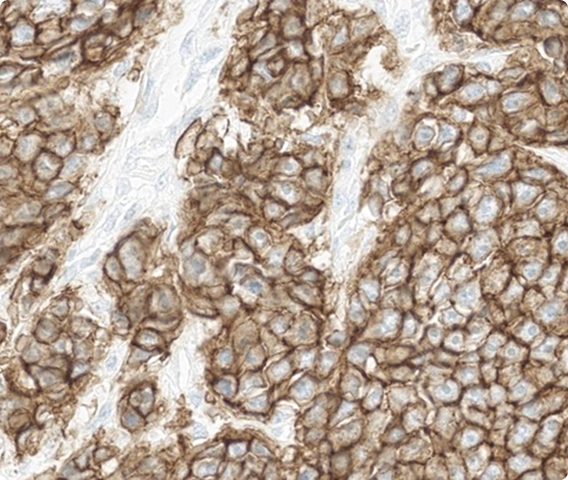 Which HER2 IHC score would you assign to this slide?