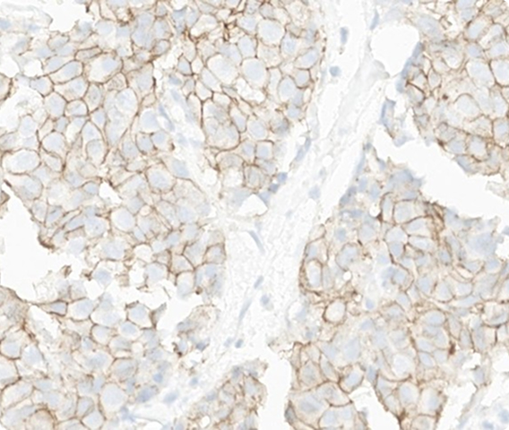 Which HER2 IHC score would you assign to this slide?