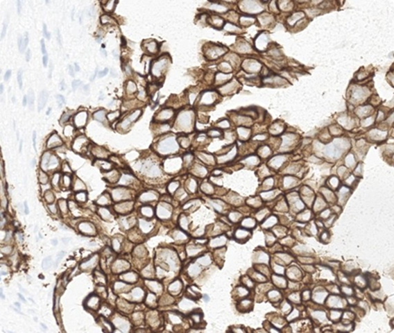 Which HER2 IHC score would you assign to this slide?