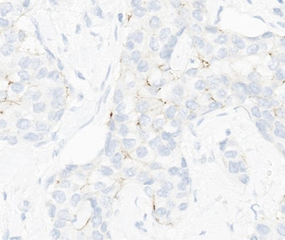 Which HER2 IHC score would you assign to this slide?
