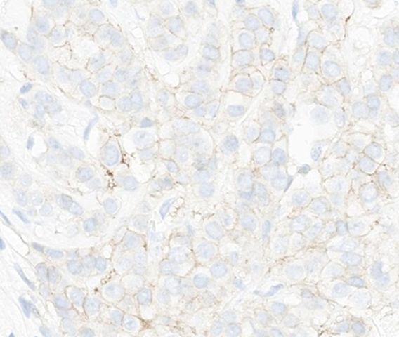 Which HER2 IHC score would you assign to this slide?