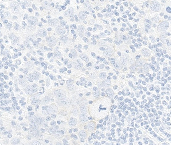 Which HER2 IHC score would you assign to this slide?