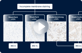 Recognizing HER2 staining patterns at the low end of the spectrum