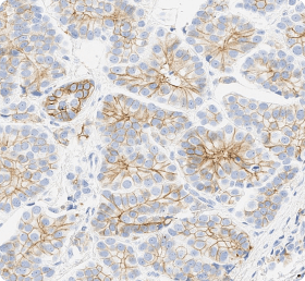 Unusual Staining Pattern: Basolateral Staining In Micropapillary Carcinoma