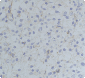 Impact Of Pre-Analytic Variables On HER2 IHC Results