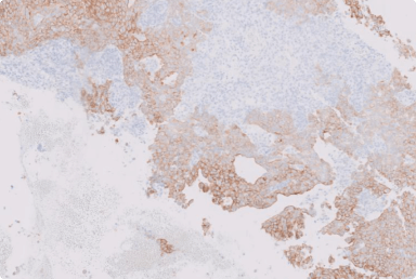 assessing-her2-ihc-with-cytoplasmic-staining.png