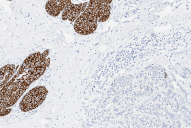 interpreting-her2-ihc-with-an-extensive-in-situ-component.png