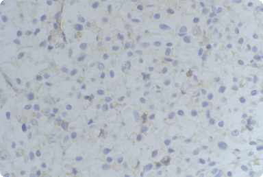 Impact Of Pre-Analytic Variables On HER2 IHC Results
