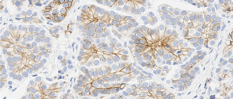 Unusual Staining Pattern: Basolateral Staining In Micropapillary Carcinoma