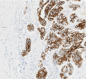 The Importance of Reporting Discrete HER2 IHC Scores