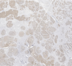 Assessing HER2 IHC with Cytoplasmic Staining