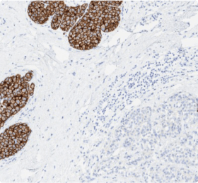 Interpreting HER2 IHC with an Extensive in Situ Component