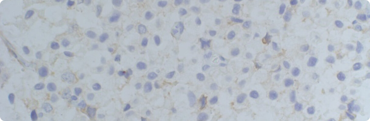 The importance of reporting discrete HER2 IHC scores