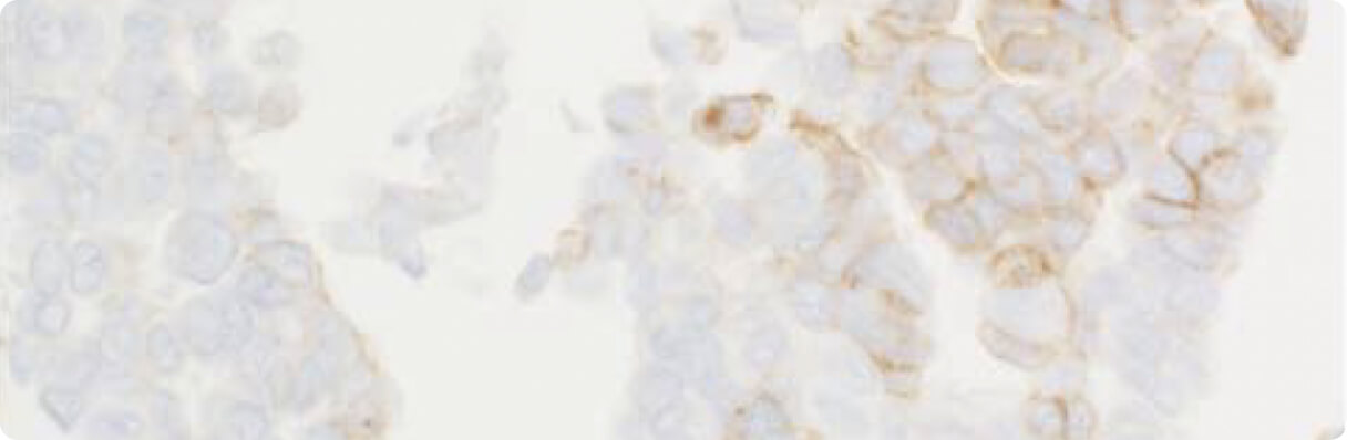 Basolateral Staining in Micropapillary Carcinoma Banner Image